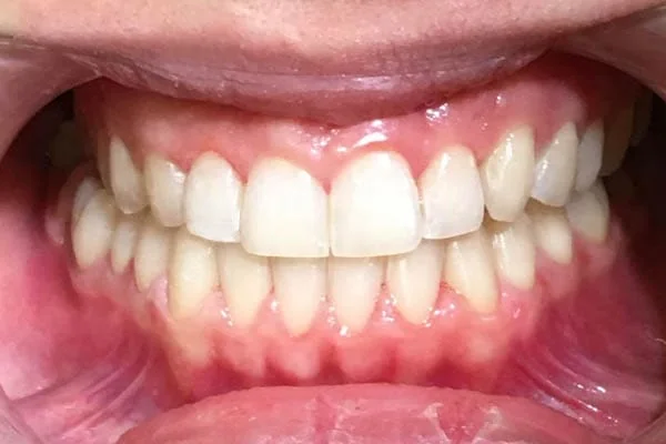 Zahnregulierung die fast unsichtbar ist